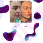 Та самая процедура, которая заменит все другие у косметолога!