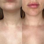 Как выглядит шея после космецевтики dr+mila tran3x?