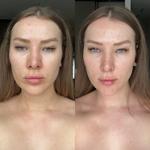 Как выглядит лицо после dr+mila tran3x